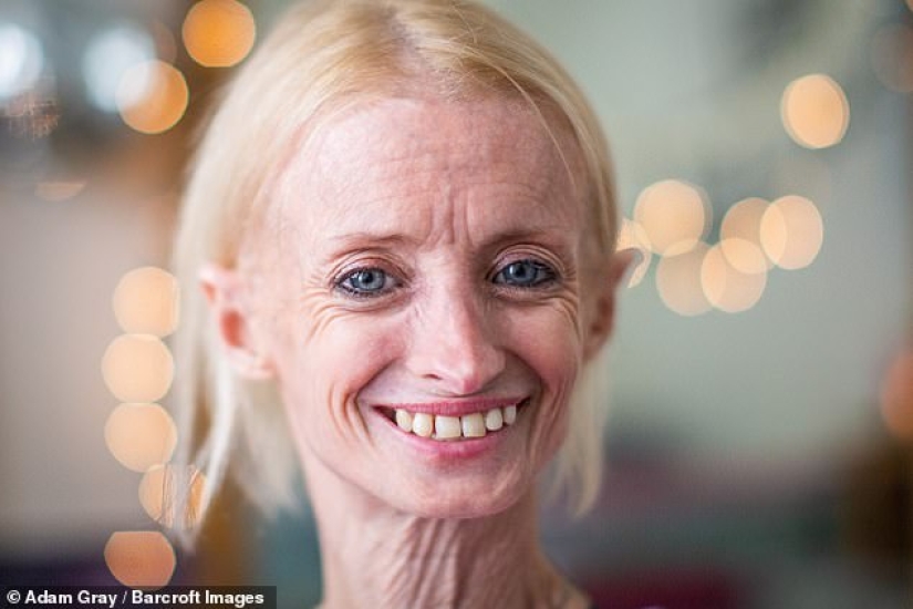 Young "old lady": a woman ages 8 times faster than usual due to "Benjamin Button" syndrome