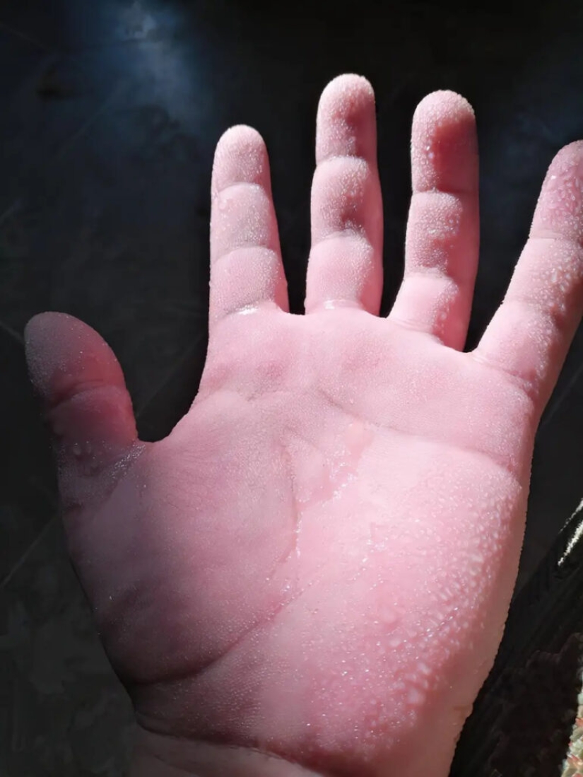 17 anomalías raras de las manos humanas