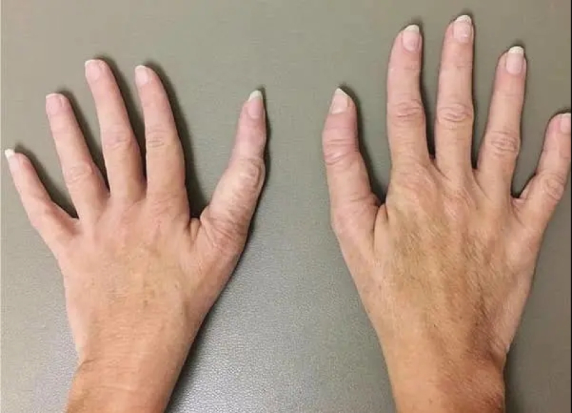 17 rare anomalies of human hands