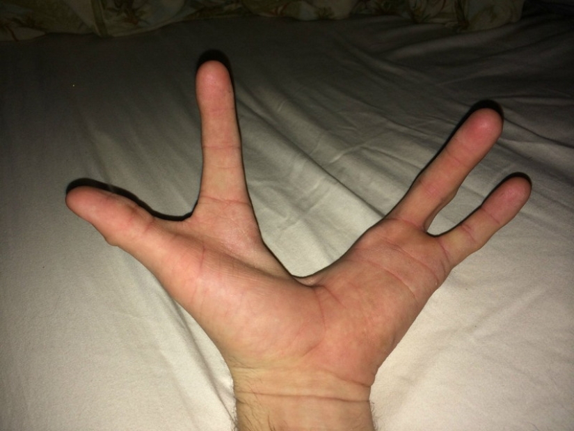 17 rare anomalies of human hands