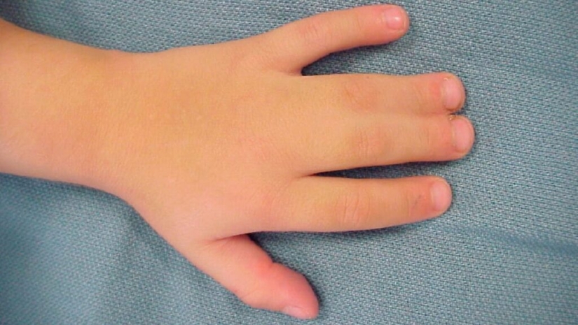 17 rare anomalies of human hands