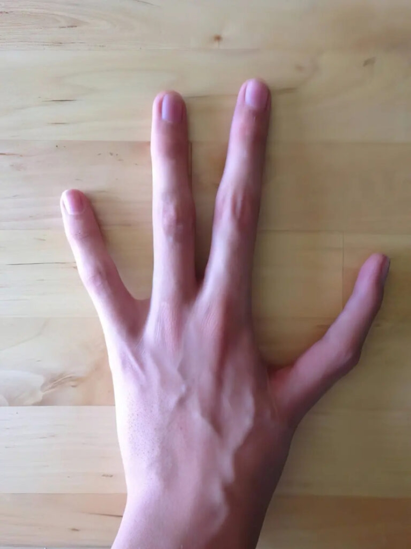 17 rare anomalies of human hands