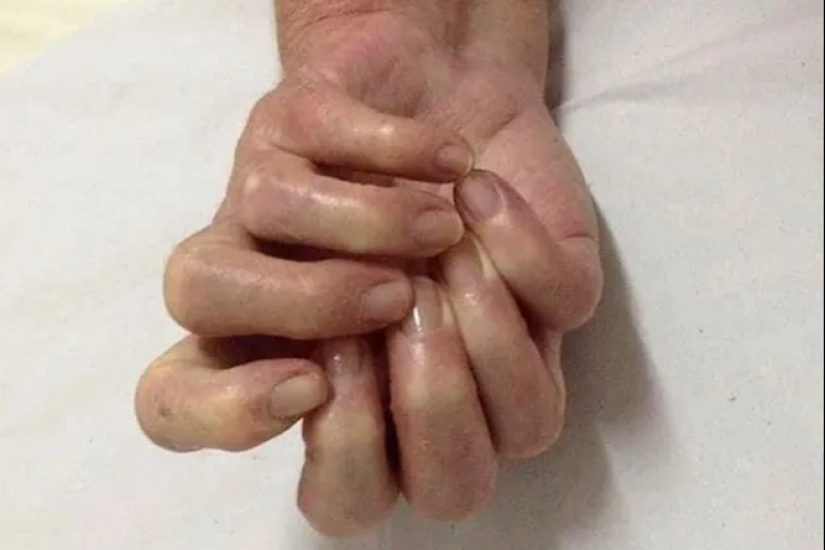 17 rare anomalies of human hands