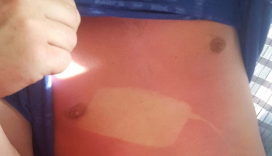 24 people who just don't know how to sunbathe
