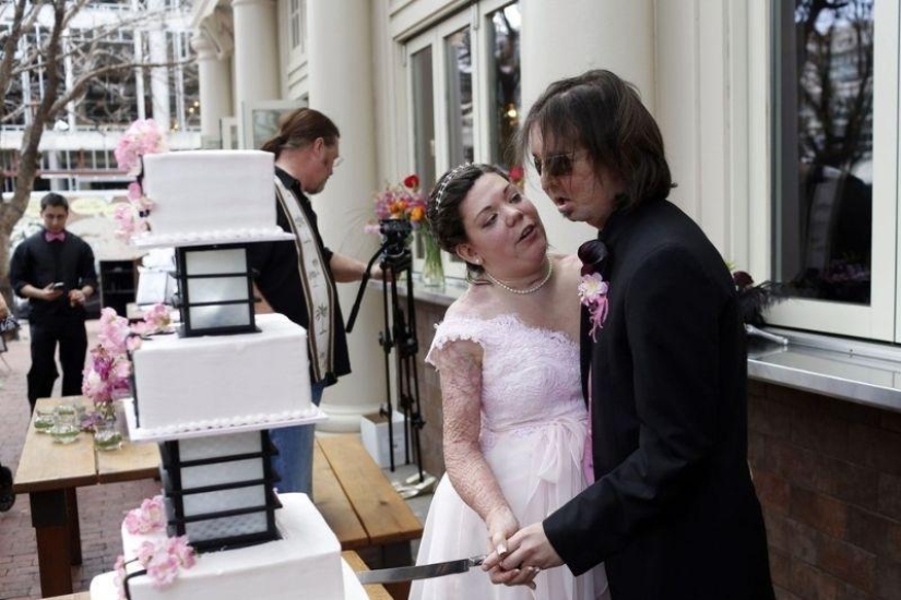 &#39;Man without a face&#39; marries after transplant