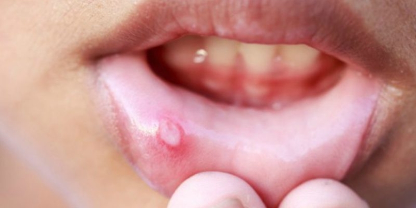 5 enfermedades inesperadas que se transmiten a través de un beso