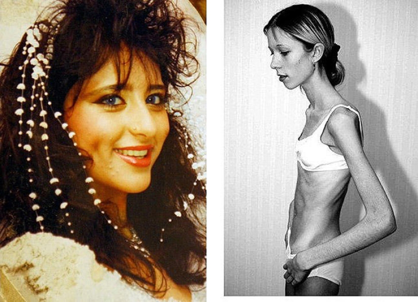 8 celebrities who died of anorexia