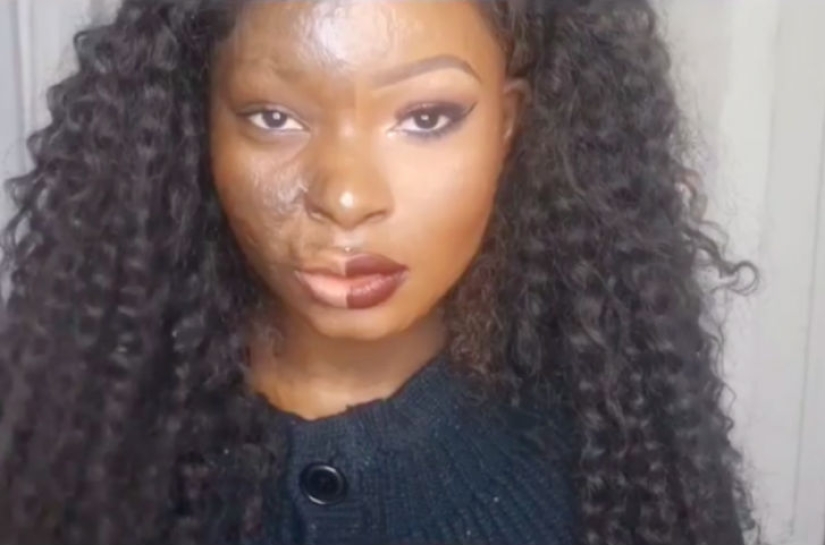 A girl with severe facial burns demonstrates the power of makeup