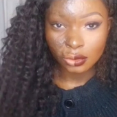 A girl with severe facial burns demonstrates the power of makeup