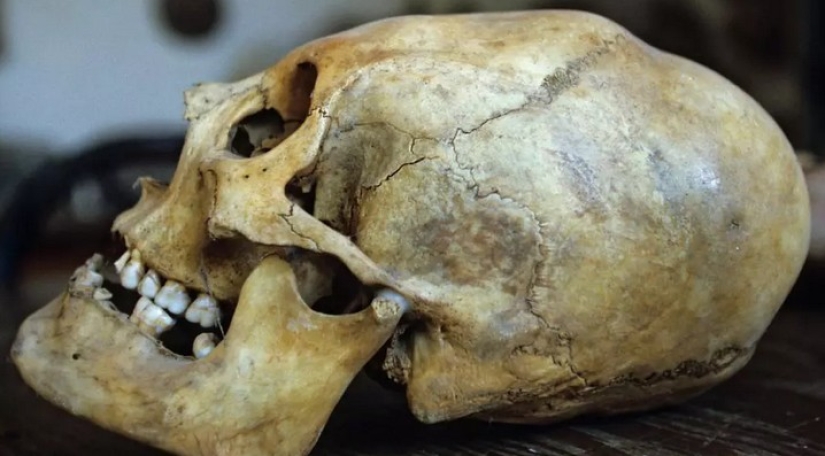 A human skull bonded with metal 2000 years ago amazed scientists