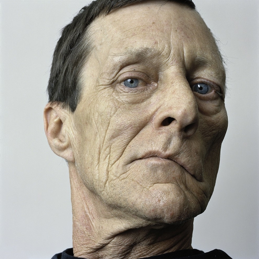 About Face: photo portraits of people suffering from paralysis