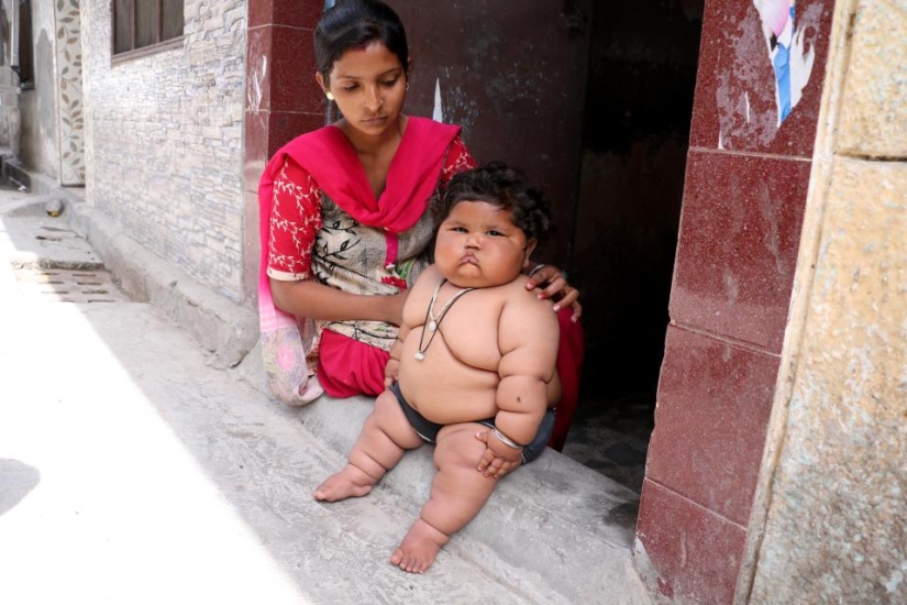 An 8-month-old girl weighs 17 kilograms, and doctors cannot diagnose her