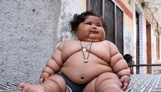 An 8-month-old girl weighs 17 kilograms, and doctors cannot diagnose her