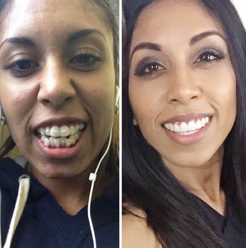 Así es como los aparatos de ortodoncia cambian radicalmente una sonrisa y la vida