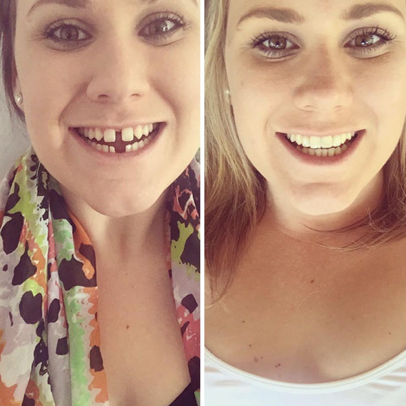 Así es como los aparatos de ortodoncia cambian radicalmente una sonrisa y la vida