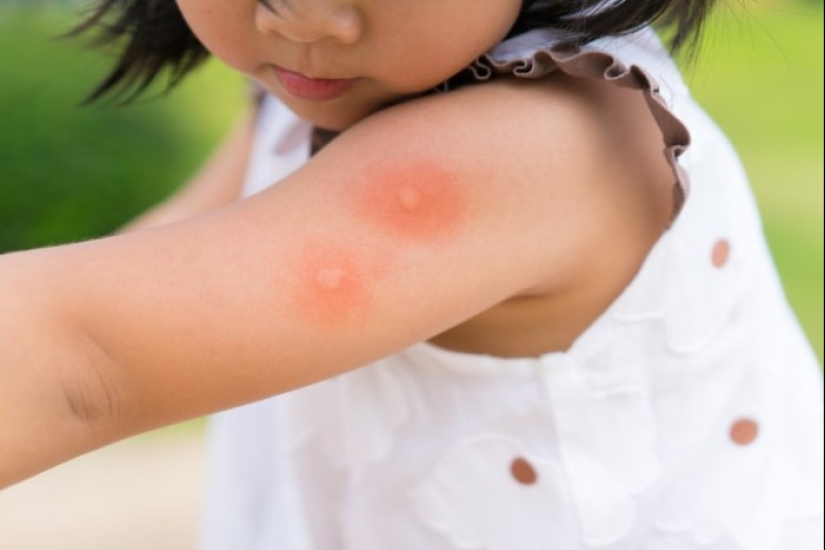 As the mosquito bites, and why a mosquito bite itches