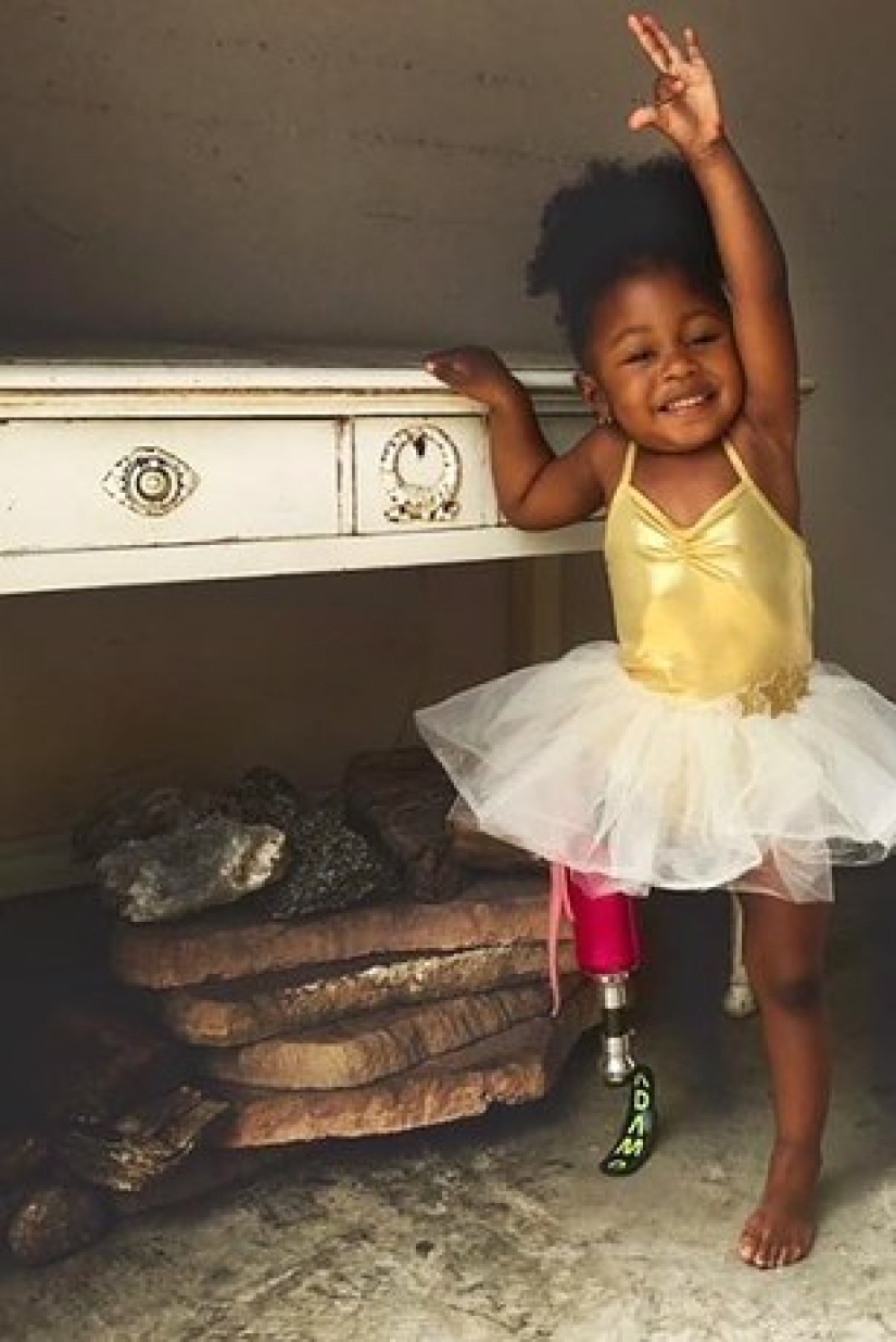 Aurora Cairo is a charming 2—year-old baby with a prosthetic leg