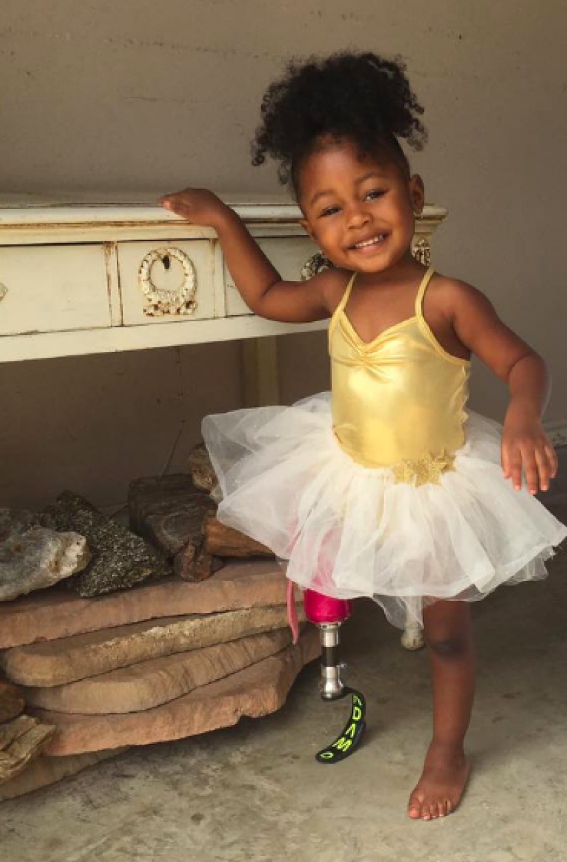 Aurora Cairo is a charming 2—year-old baby with a prosthetic leg