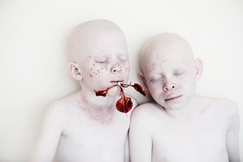 Blancura mortal: Retratos increíbles de los albinos de Tanzania