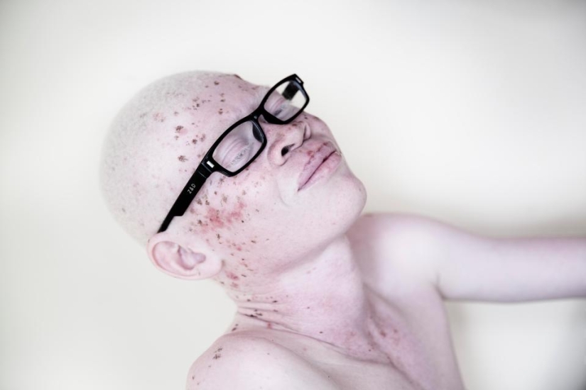 Blancura mortal: Retratos increíbles de los albinos de Tanzania