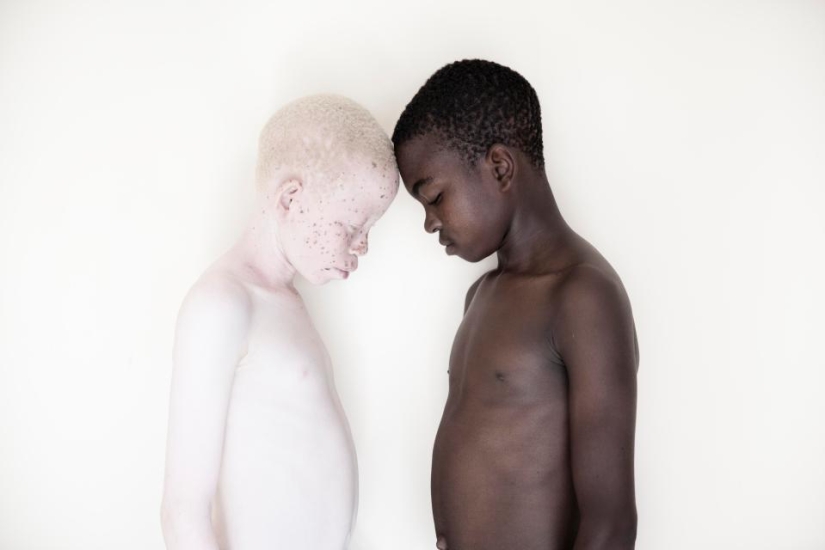 Blancura mortal: Retratos increíbles de los albinos de Tanzania