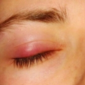 Cebada en el ojo, qué tipo de enfermedad es esta. ¿Qué causa la cebada?