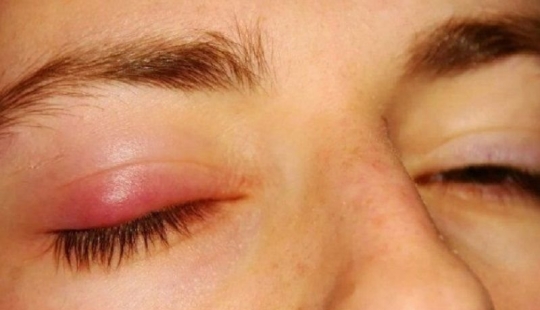 Cebada en el ojo, qué tipo de enfermedad es esta. ¿Qué causa la cebada?