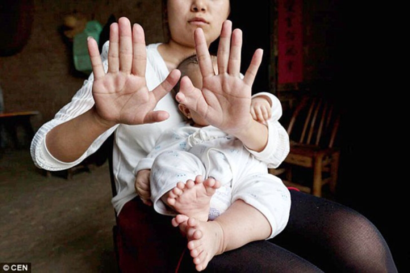 Chinese boy born with 31 fingers