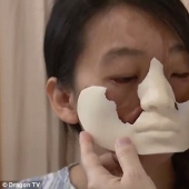 Chinese woman with deformed face doctors grow a new face on her chest