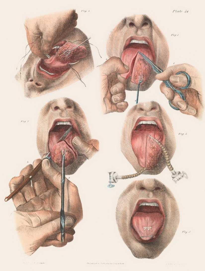 Cómo se hacían las cirugías a principios del siglo pasado