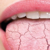 ¿De dónde vienen las grietas en la lengua y qué tan peligroso es?