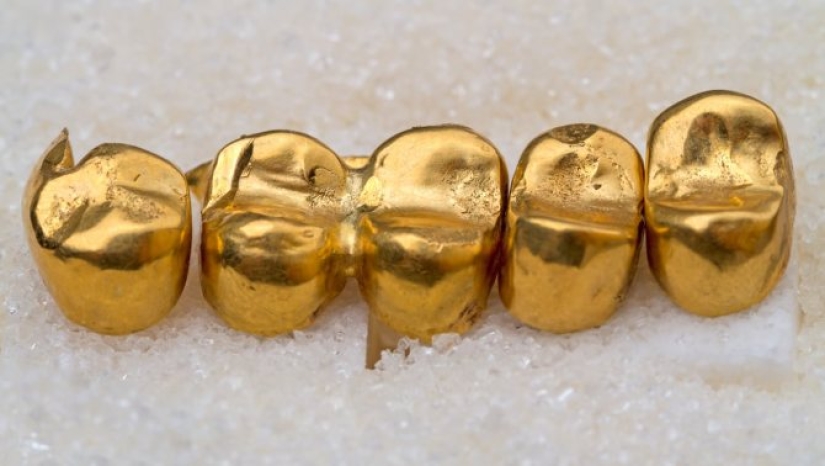 Dead Man's Gold: What happens to gold crowns during cremation