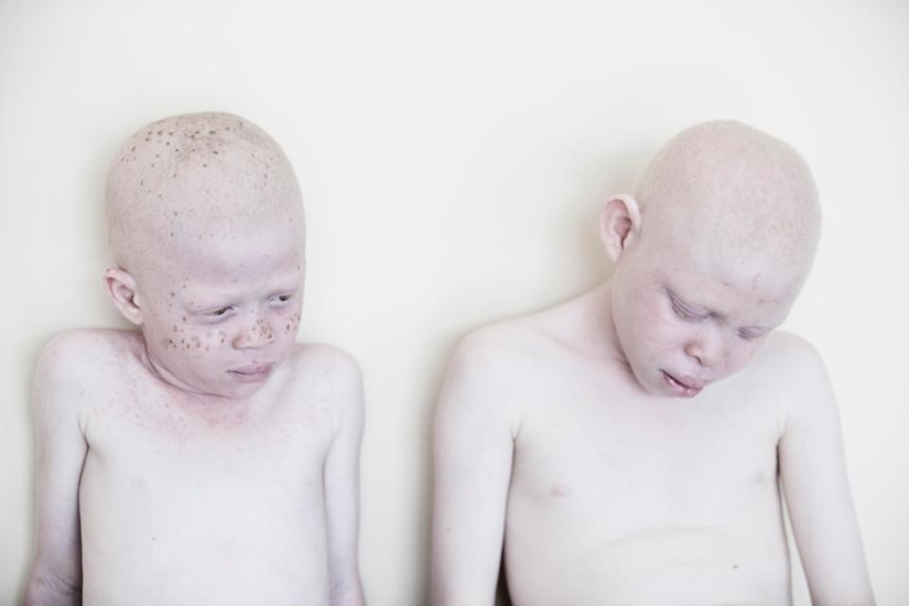 Deadly Whiteness: Incredible portraits of Tanzania's Albinos