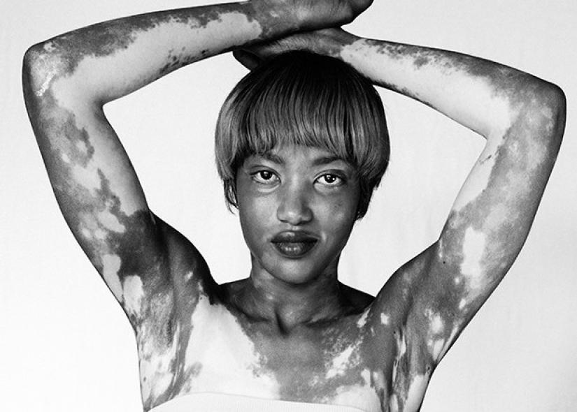 Discover the beauty of vitiligo