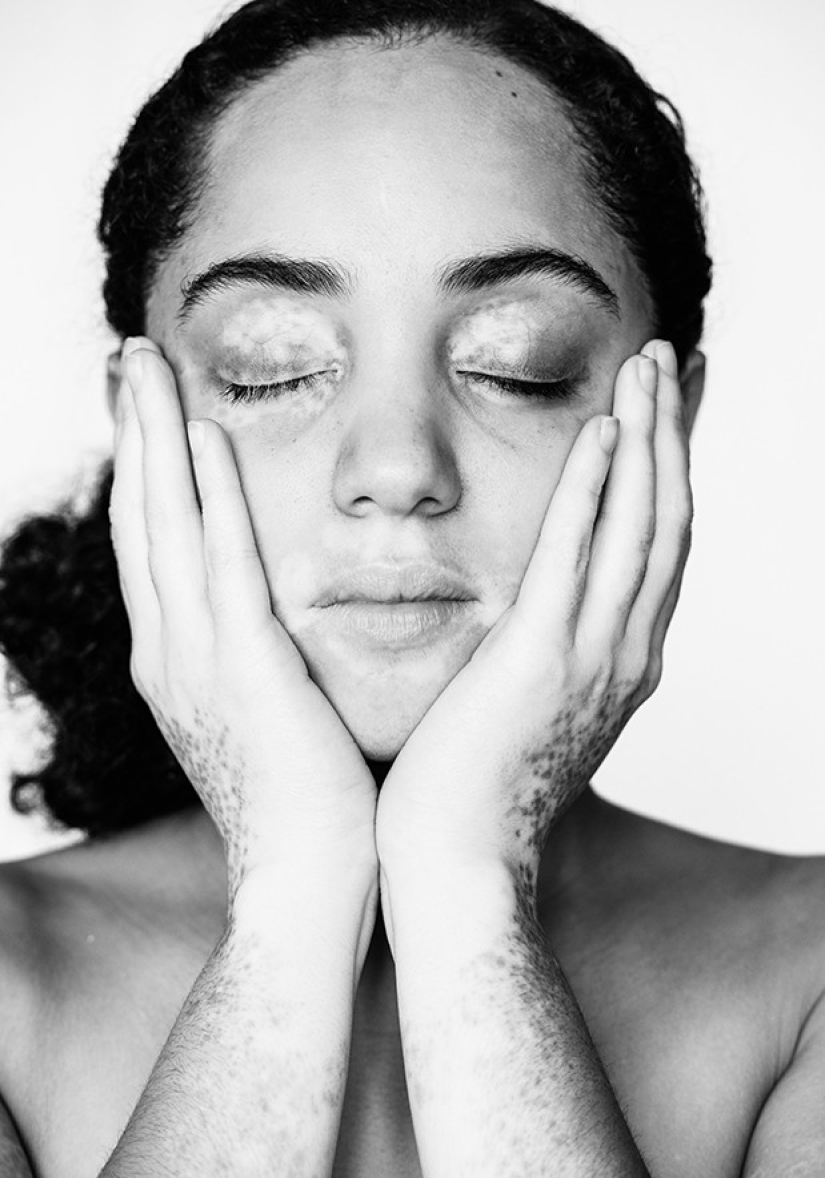Discover the beauty of vitiligo