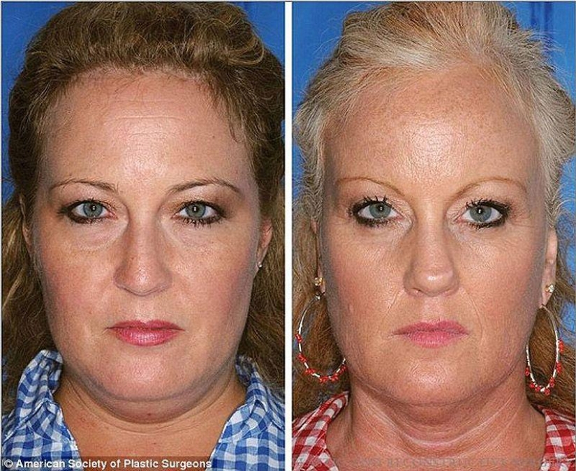 Effects of smoking on the example of twins