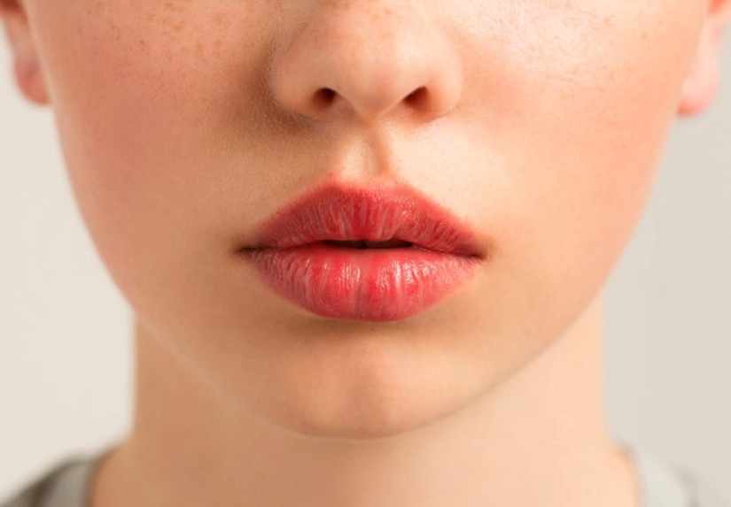 Eliminamos el rostro triste, insatisfecho junto con las arrugas nasolabiales y aumentamos el volumen de los labios
