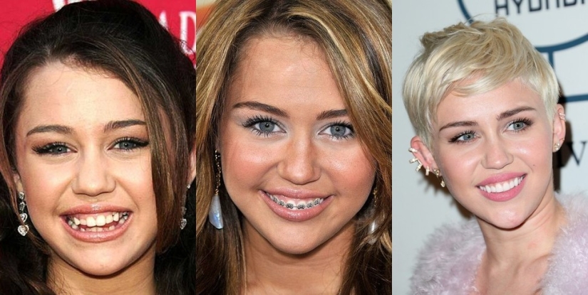 Estas celebridades te mostrarán cómo los frenos pueden cambiar drásticamente tu sonrisa