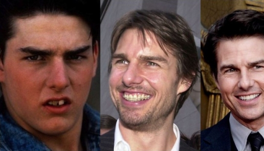 Estas celebridades te mostrarán cómo los frenos pueden cambiar drásticamente tu sonrisa