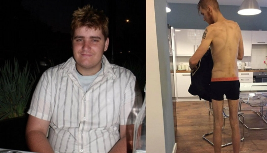 Everything is good in moderation: an obese man lost half his weight and became like Koshchei the Immortal