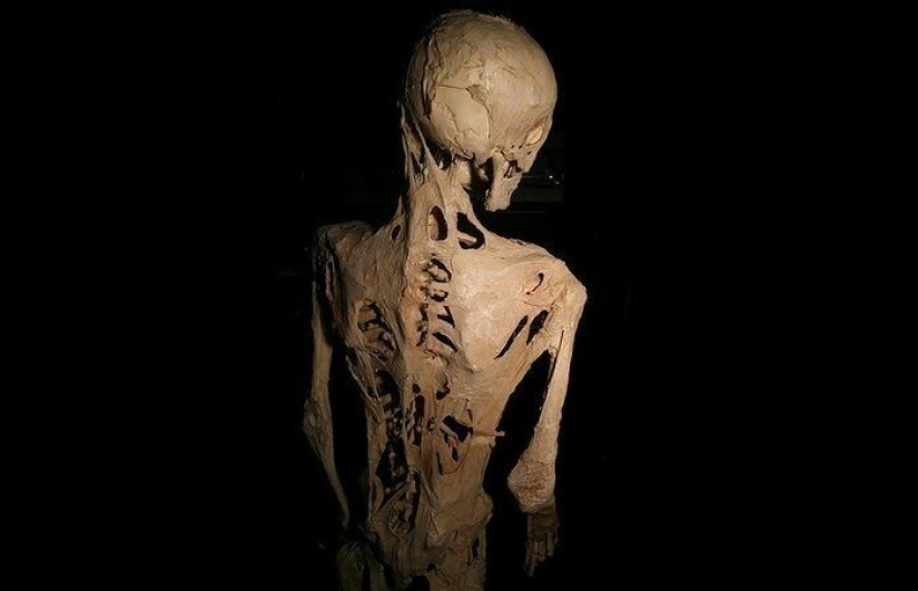 Fibrodysplasia is a terrible disease that turns a person into a bone idol
