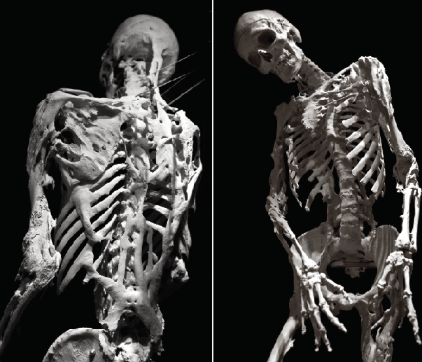 Fibrodysplasia is a terrible disease that turns a person into a bone idol