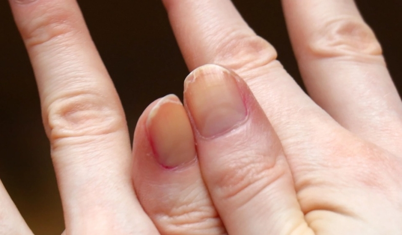 From arthritis to melanoma: 10 signs of serious diseases that can be identified by nails