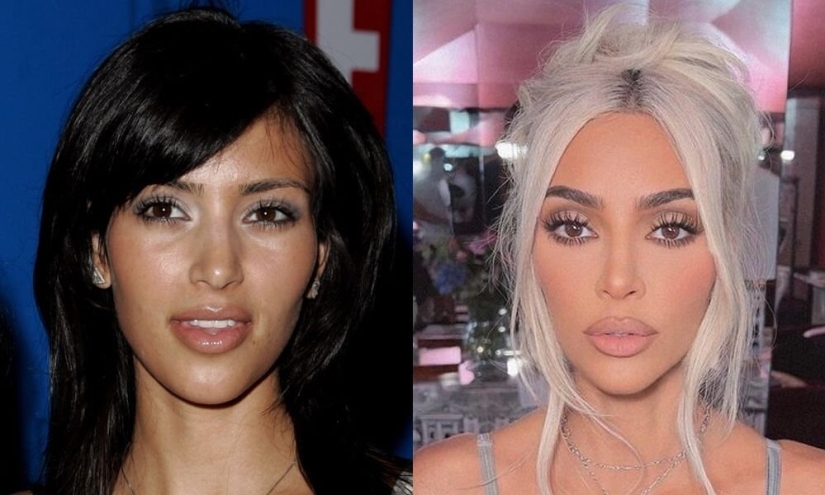 Getting plastic surgery was the best decision: 10 miraculous transformations of stars