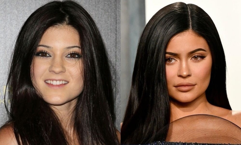 Getting plastic surgery was the best decision: 10 miraculous transformations of stars