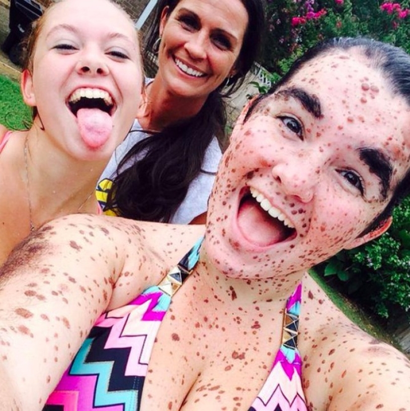 Girl with rare skin condition takes pride in being different