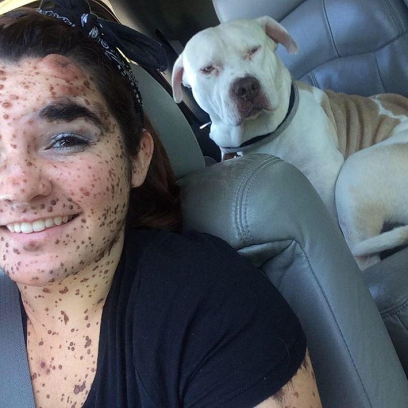 Girl with rare skin condition takes pride in being different