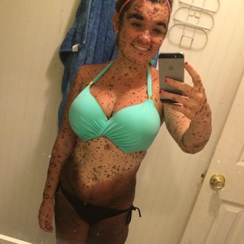 Girl with rare skin condition takes pride in being different