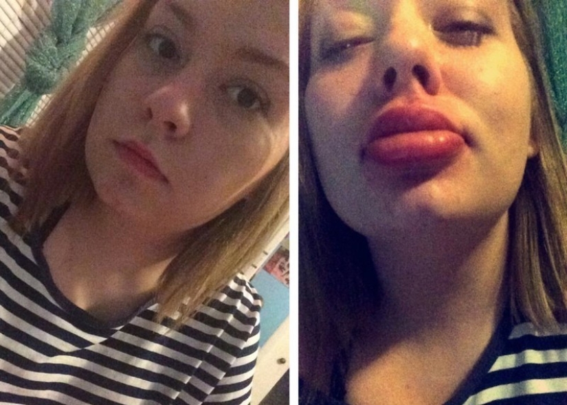 Girls try to make their lips plump like a TV star. It doesn&#39;t turn out very...