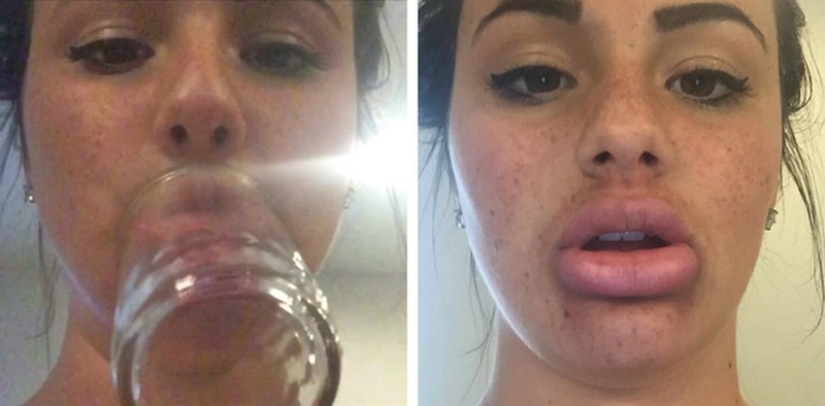 Girls try to make their lips plump like a TV star. It doesn&#39;t turn out very...